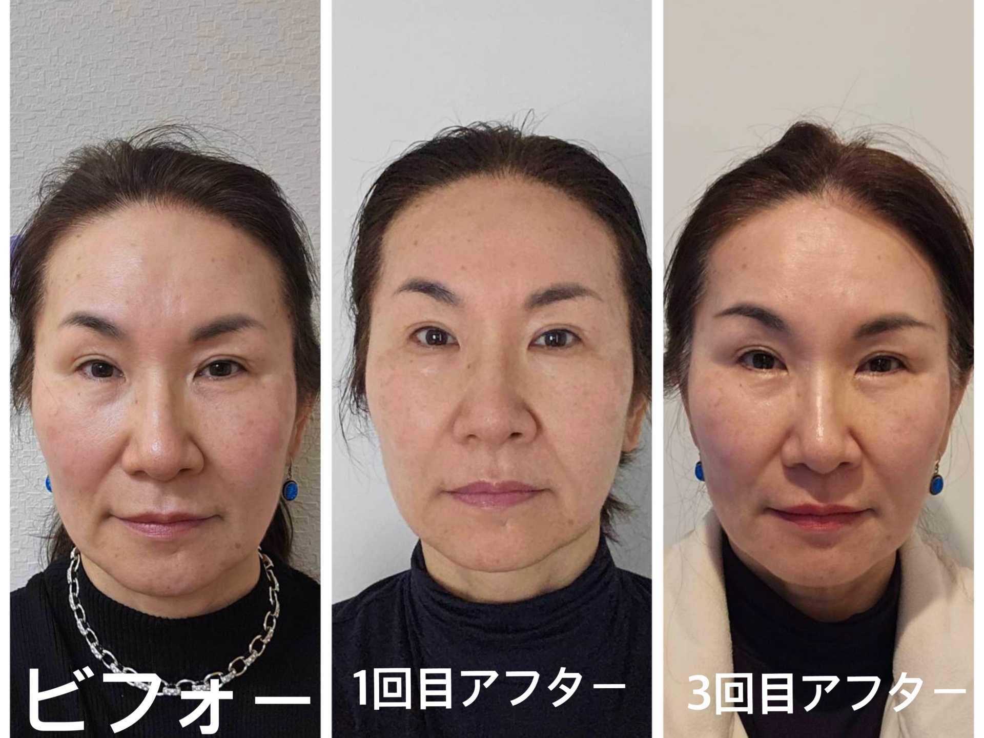 3回目の小顔矯正でしっかり効果が出てきました。顔巾がせまくなりシャープに。肌艶も良くなられました❣️